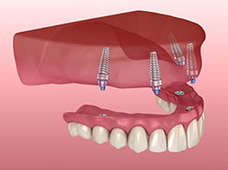 implants